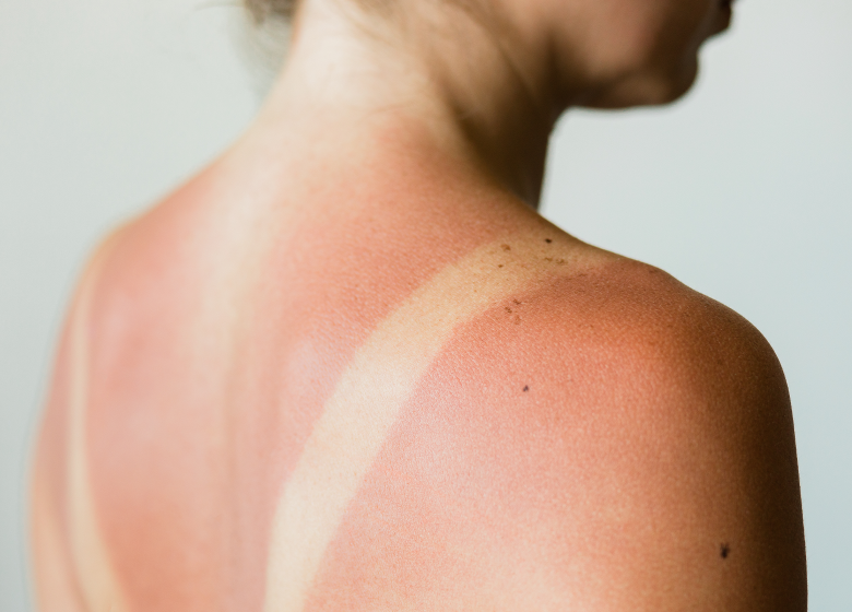 Sonnenverbrannter Rücken einer Frau mit Abdruck von Badeanzug-Trägern symbolisiert Sonnenschäden auf der Haut