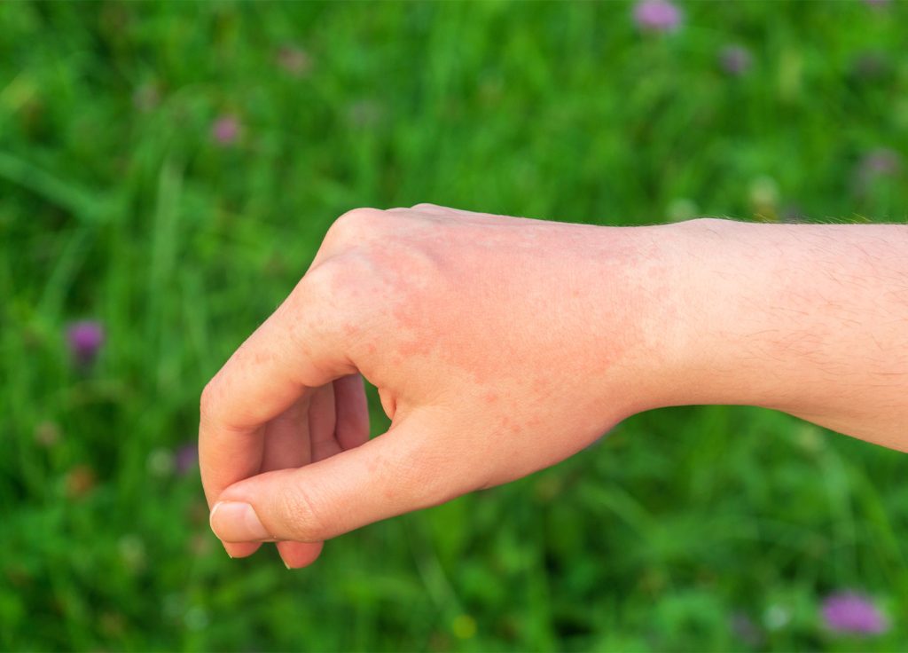 Sonnenallergie auf Handrücken symbolisiert Sonnenschäden der Haut