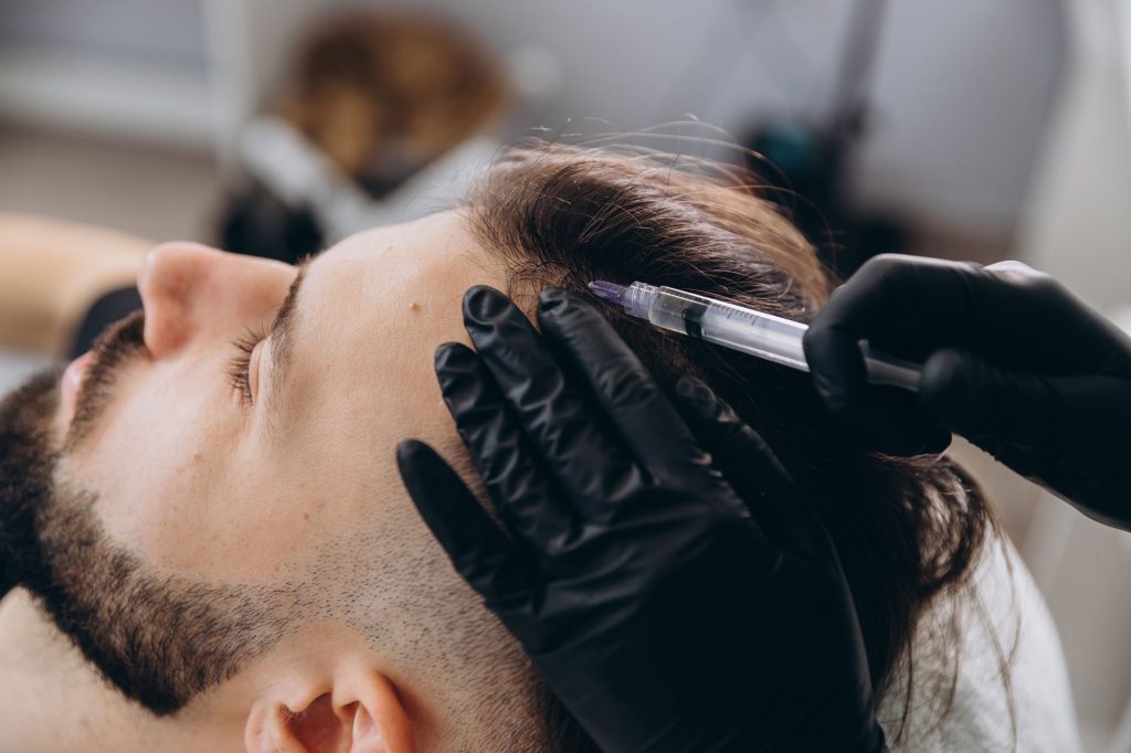mann-erhaelt-injektion-in-die-kopfhaut-eigenbluttherapie-mit-prp-oder-prf