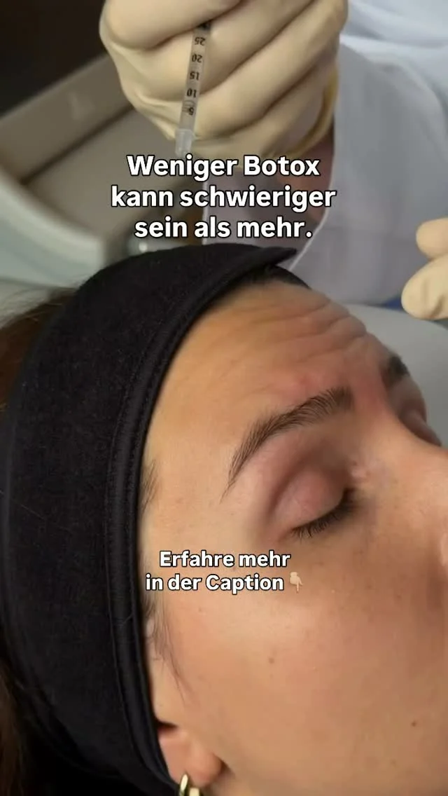 Ein komplett ruhiger Muskel ist vergleichsweise einfach zu erreichen.

Die Kunst beginnt dort, wo wir sagen:

Wir möchten Falten reduzieren – aber natürliche Bewegung erhalten.

Genau das ist die Idee hinter niedrig dosierten Botox-Behandlungen.

Dabei geht es nicht darum, einfach pauschal weniger Produkt zu verwenden. Viel wichtiger sind die exakten Injektionspunkte, die individuelle Muskelaktivität und die Anatomie des jeweiligen Gesichts.

Denn kein Gesicht bewegt sich exakt wie das andere.

Manche Menschen ziehen ihre Augenbrauen stark nach oben, andere arbeiten besonders stark mit der Zornesfalte oder der Muskulatur um die Augen.

Deshalb behandle ich lieber zunächst konservativer.

Nach ein bis zwei Wochen kann man das Ergebnis beurteilen und gegebenenfalls etwas ergänzen.

Was man dagegen nicht machen kann: Ein bereits zu stark behandeltes Ergebnis einfach am nächsten Tag wieder rückgängig machen.

Gerade bei Botox ist Geduld oft die bessere Strategie als Überkorrektur.

Aber wie immer gilt mein Rat: Lasst euch individuell beraten, um herauszufinden, was für euer Gesicht „zu viel“ oder „zu wenig“ ist. Denn das hängt von euren ganz persönlichen Gesichtszügen und Proportionen ab und lässt sich nicht pauschal über Instagram beurteilen.